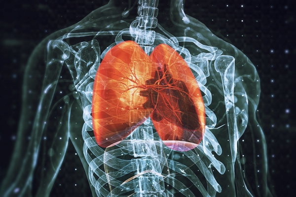 Lung Cancer Causing Biomarkers Can Now Be Detected More Rapidly
